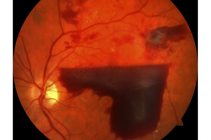 Ilustračný obrázok k článku Unikátna operácia v Žiline: Pacientovi s cukrovkou zachránili zrak