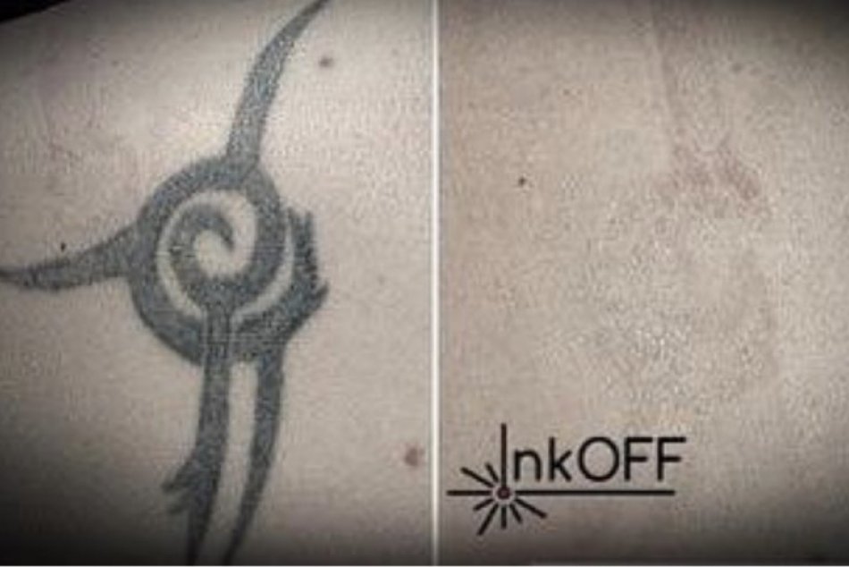 Odstraňovanie tetovania v žilinskom InkOff.